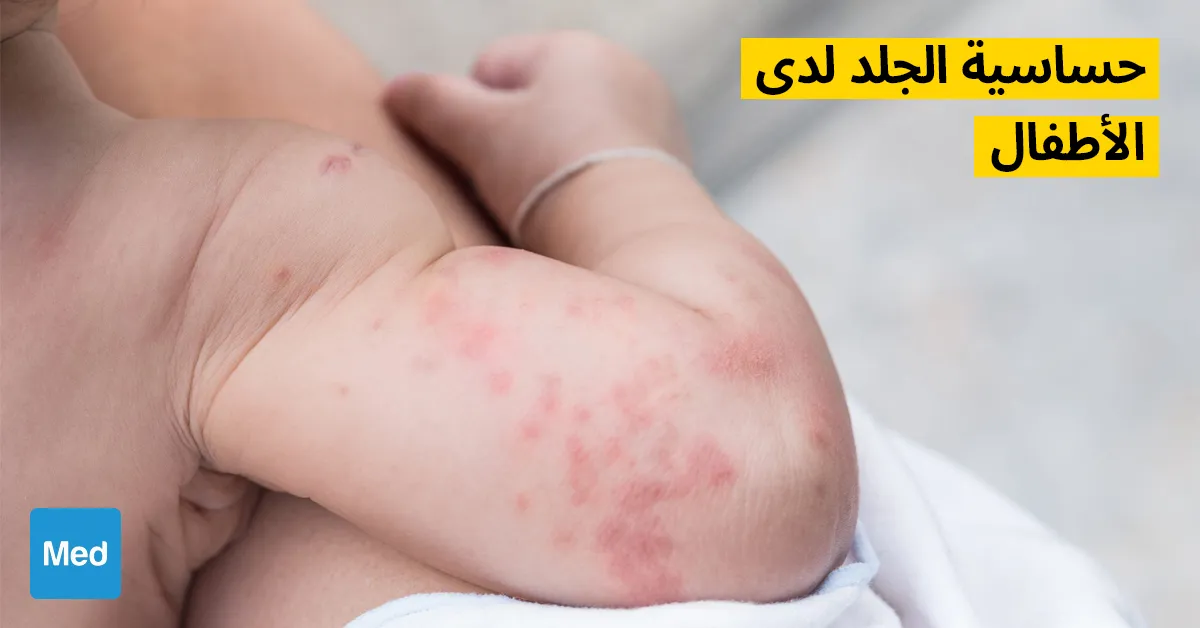 حساسية الجلد لدى الأطفال